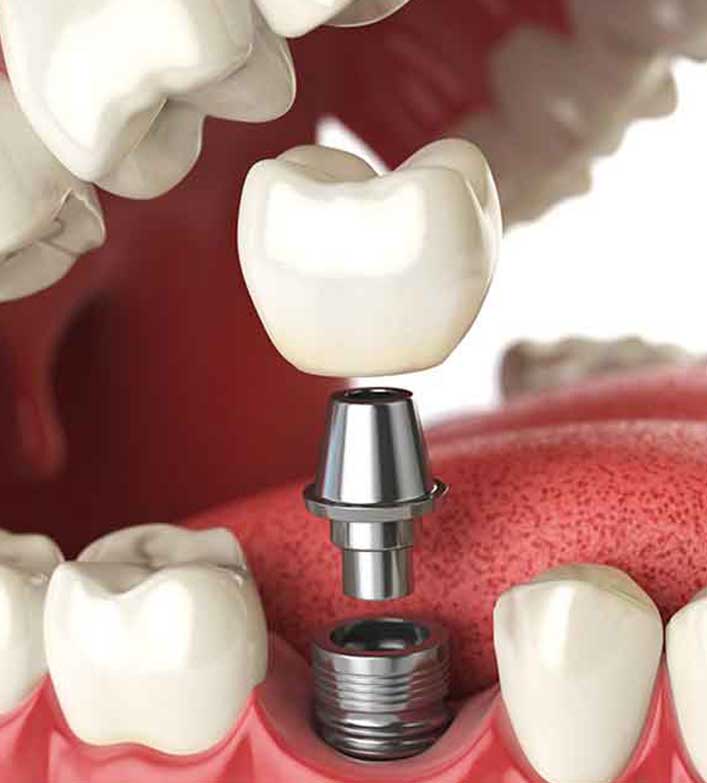 Dental Implants | Legacy Family Dental