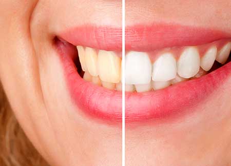 Teeth Whitening | Legacy Family Dental